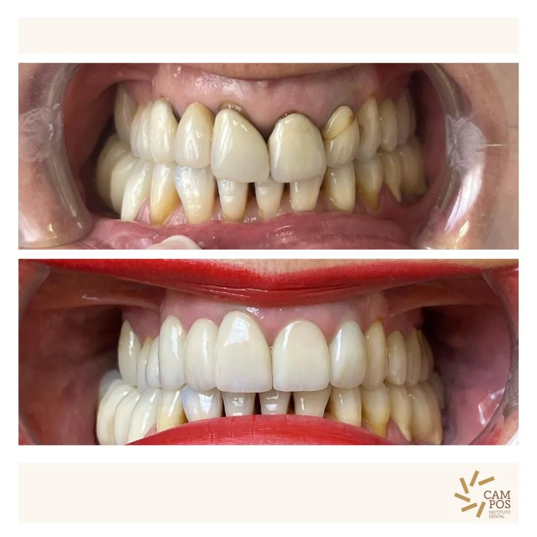 Caso real antes y después de un tratamiento en el Instituto Dental Campos