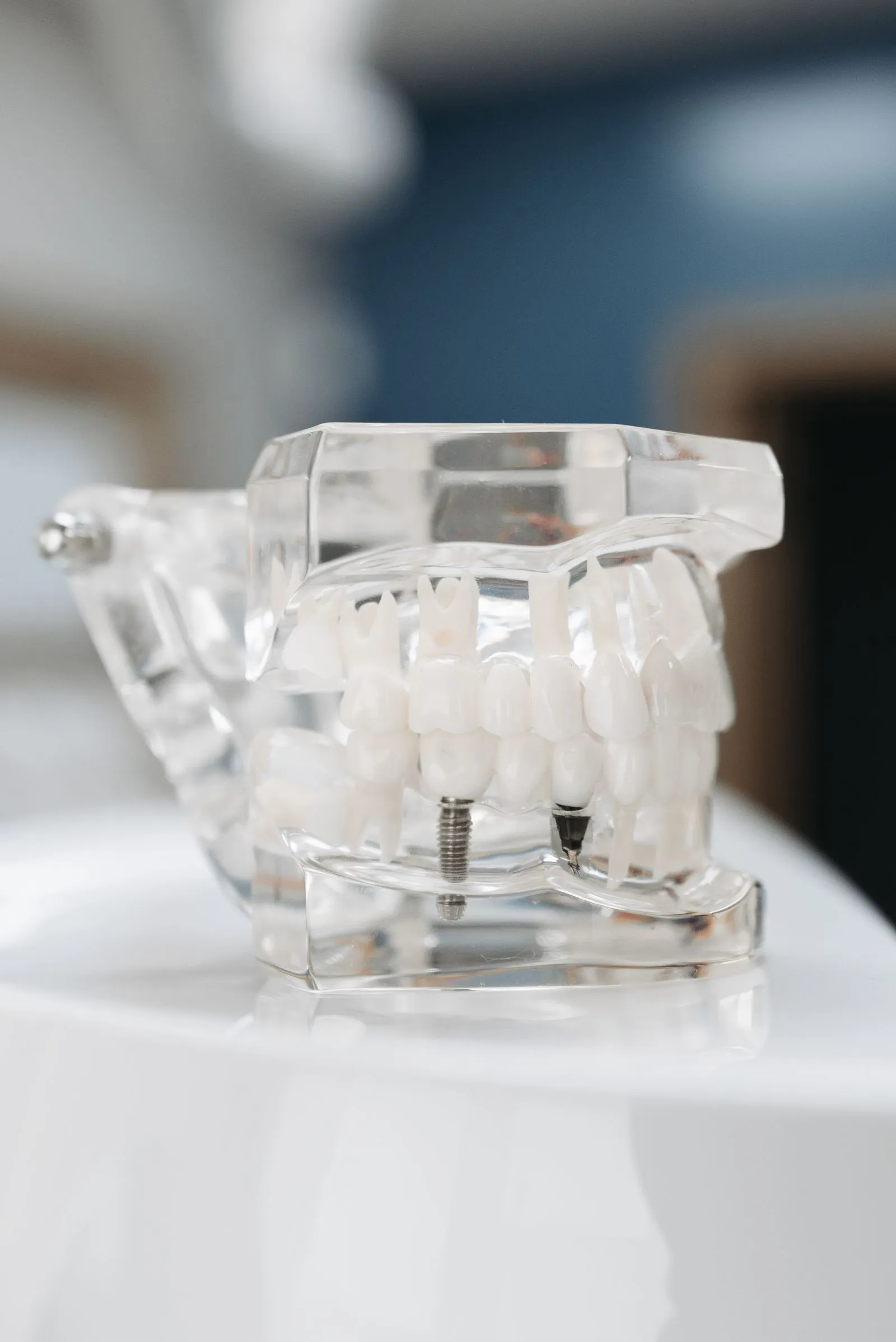 Modelo dental transparente que muestra un implante de titanio, en el Instituto Dental Campos