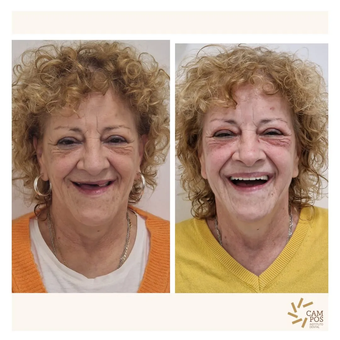 Caso real antes y después de una rehabilitación de la sonrisa en el Instituto Dental Campos